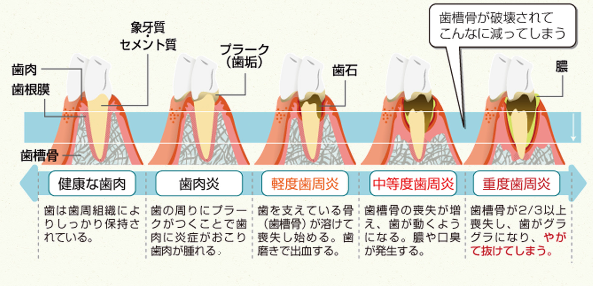 歯周病の進行の様子