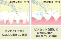 歯の揺れ具合