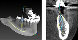 歯科用CT