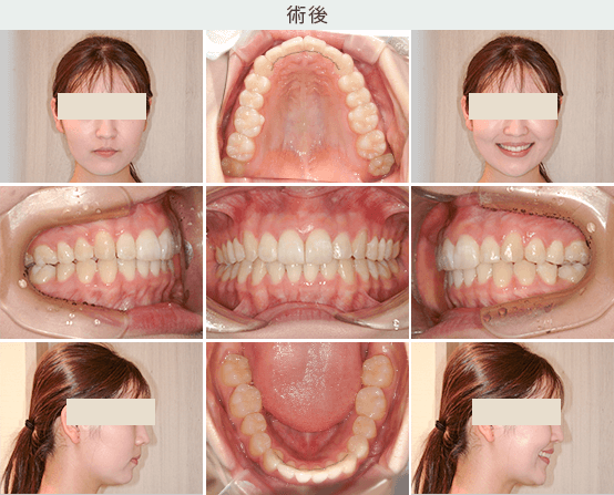 26才女性症例 術後写真