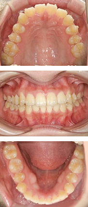 矯正中（約6ヶ月後）