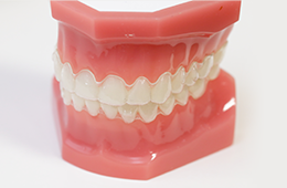 マウスピース矯正の見本の写真