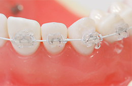 ワイヤー矯正の見本の写真