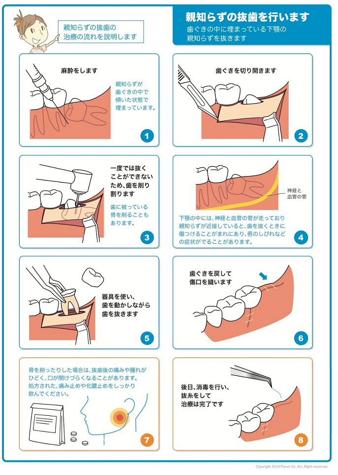 怖い 親知らず 抜歯